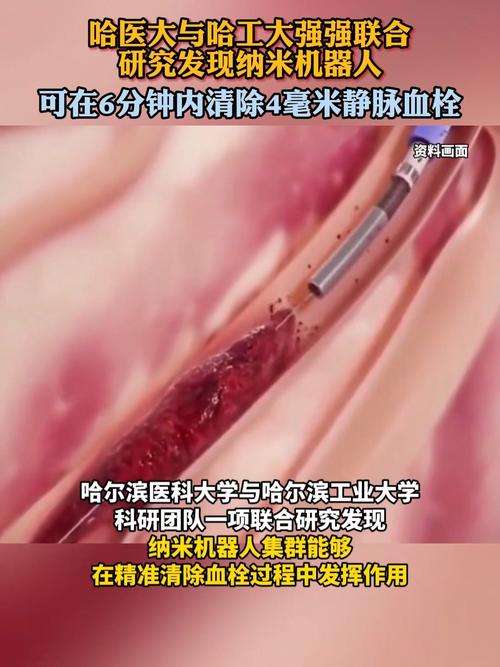 纳米机器人清除血栓实录(纳米机器人清理血栓真的假的)